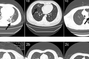 Modelo de aprendizaje profundo utilizado para detectar neumonía en pacientes con COVID-19 a través de imágenes computarizadas